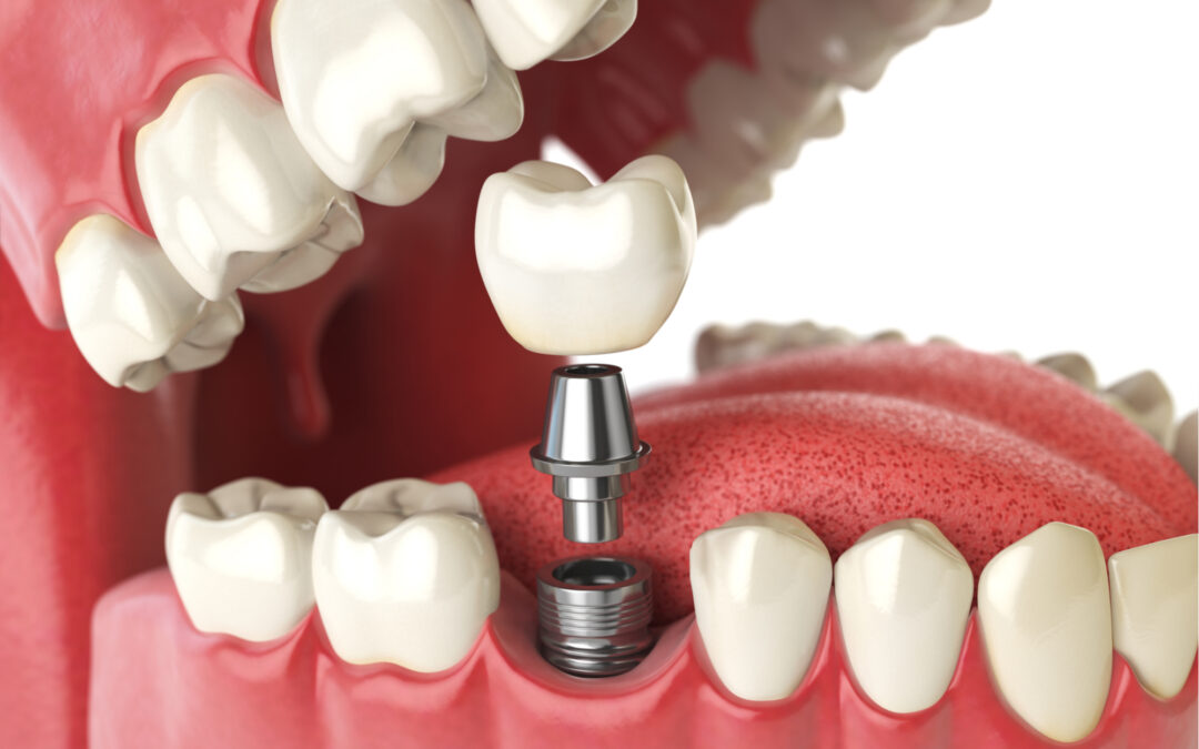 What You Need to Know About Dental Implants