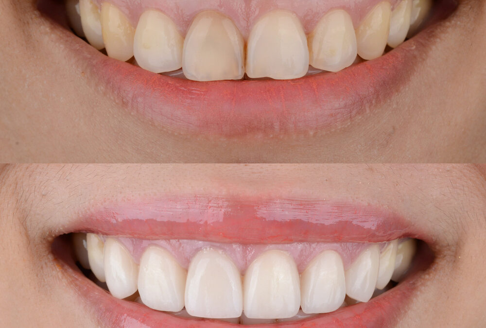 What Are the Best Teeth Whitening Methods?