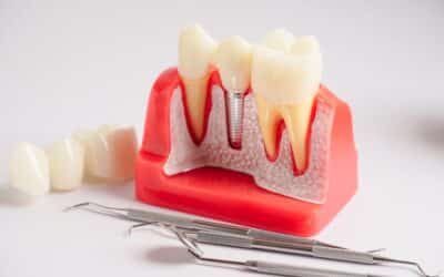Dental Implants Versus Denchers: How To Choose The Best Option For You