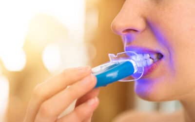 Why At-Home Whitening Kits Don’t Match Professional Results