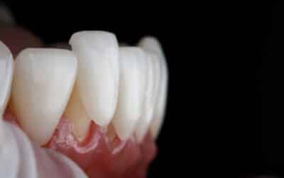 How Veneers Can Transform Your Smile in Illinois