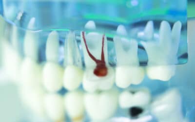 Root Canals Vs. Tooth Extractions: Which Is Best For Saving Your Tooth?